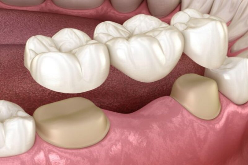 Khoảng để đưa răng mọc cao về cung hàm có thể được