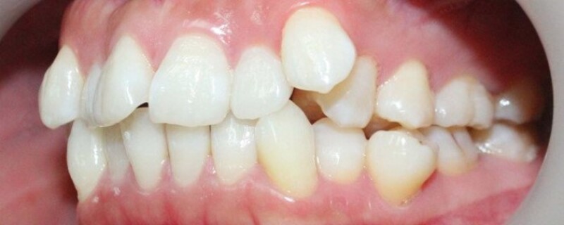 Nếu răng đã mọc ra khỏi lợi và có thể gắn khí cụ trực tiếp, quá trình thường đơn giản hơn.