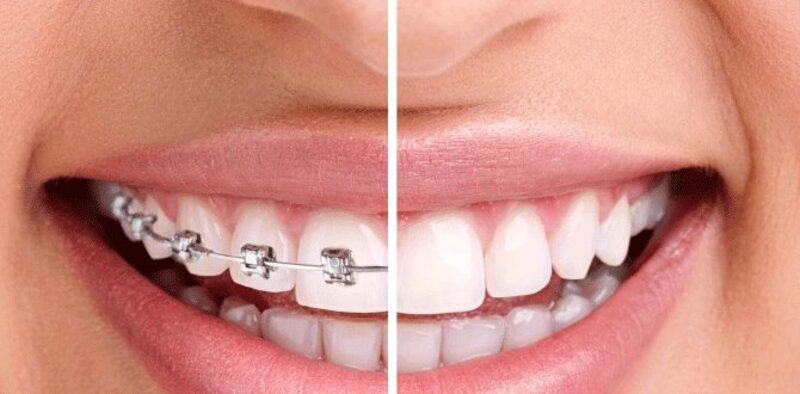 Có. Răng nanh mọc cao trên lợi có thể được kéo xuống