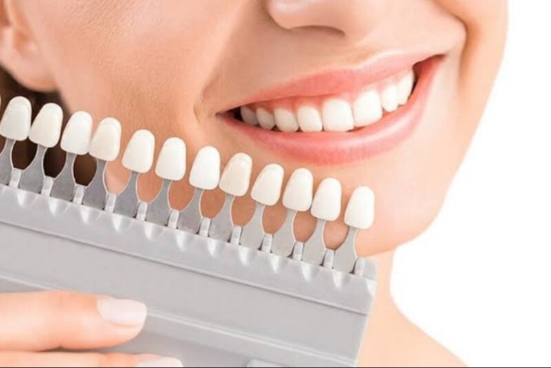 Dán sứ Veneer phù hợp với răng thưa nhẹ, khe nhỏ,