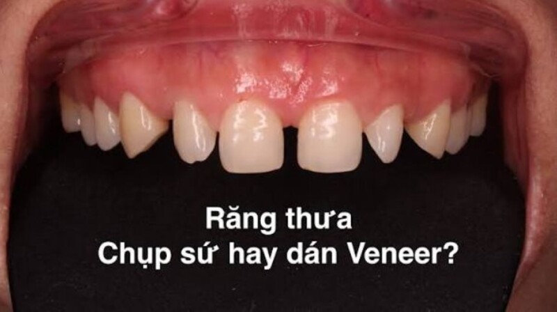Răng thưa nên niềng khi khe thưa lớn