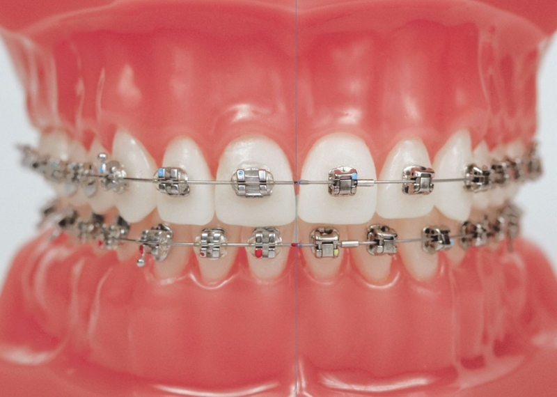 Sai khớp cắn do xương hàm nặng có thể cần kết hợp niềng răng