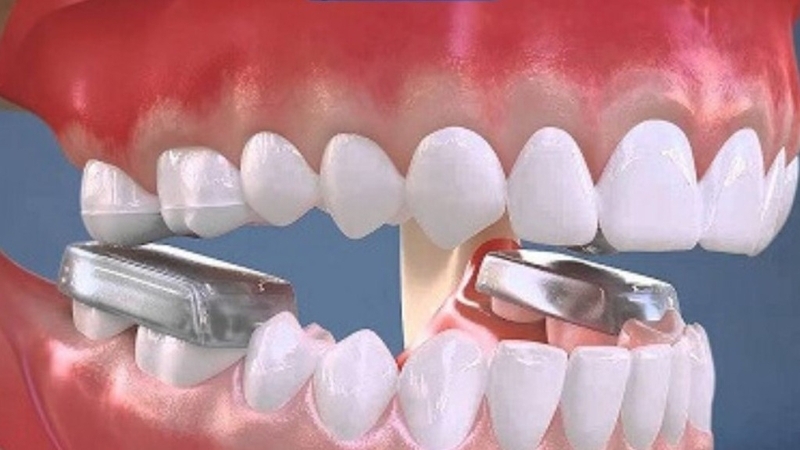 Tuổi cao không làm mất khả năng niềng sai khớp cắn