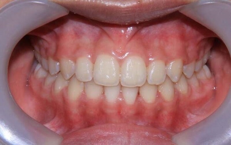 Niềng sai khớp cắn thường kéo dài khoảng 6–36 tháng