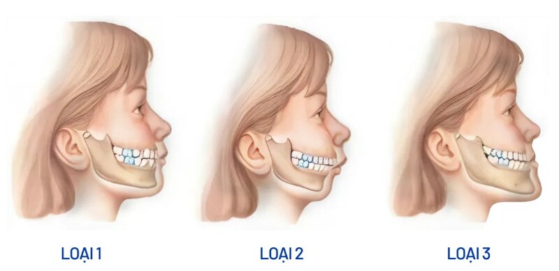 Niềng sai khớp cắn giúp đưa răng về vị trí phù hợp