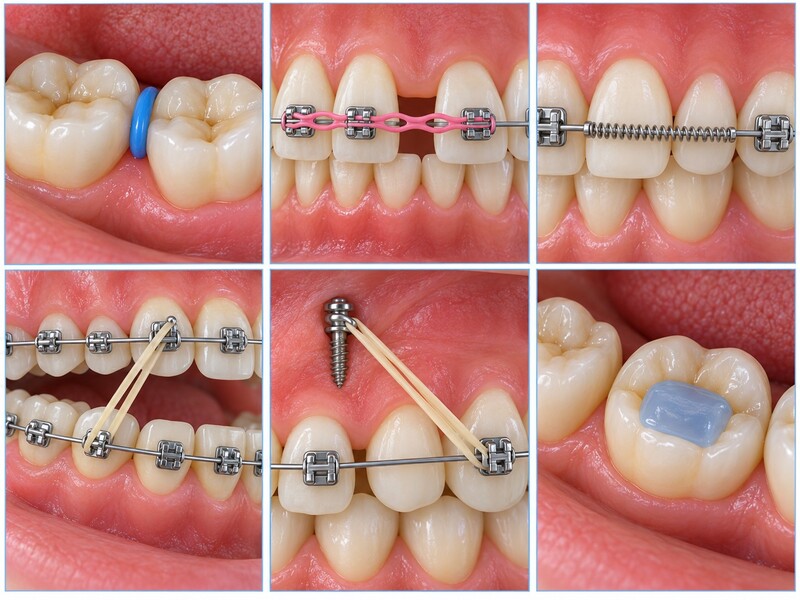 Thun tách kẽ, chun chuỗi, lò xo, chun liên hàm, minivis và gờ nâng khớp cắn