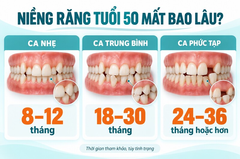 Thời gian niềng phụ thuộc mức độ sai lệch, nha chu, răng mất và mục tiêu điều trị, không chỉ phụ thuộc tuổi.