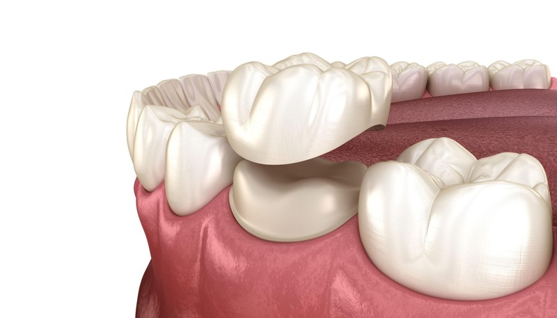 Răng, nướu và khớp cắn cần được đánh giá trước khi làm mão sứ