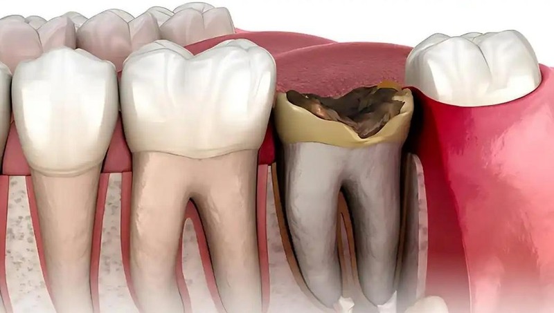 Răng người trẻ cần được bảo tồn mô răng và đánh giá tình trạng tủy cẩn thận