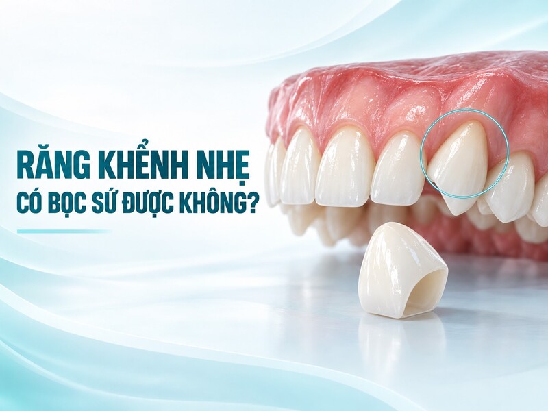 Răng khểnh nhẹ, khớp cắn cân đối có thể bọc sứ khi lượng mô răng cần sửa soạn nằm trong giới hạn an toàn.