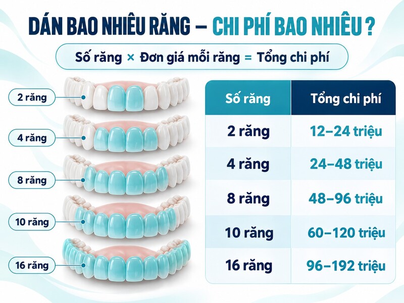 Chi phí dán sứ Veneer cho 2 4 8 10 và 16 răng