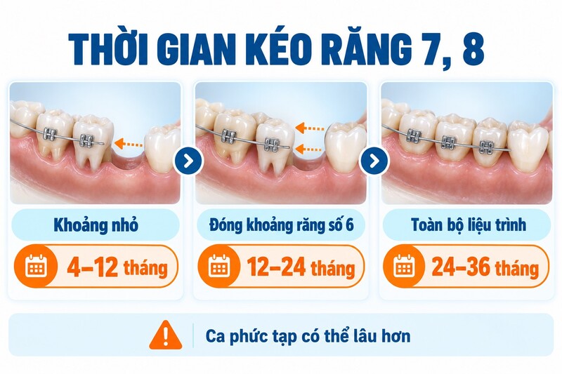 Thời gian kéo răng 7 8 đóng khoảng mất răng