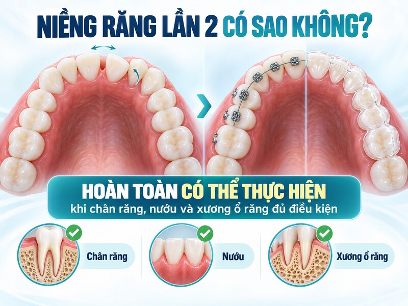 Niềng răng lần hai cần được thực hiện khi răng chạy lại, vẫn còn hô
