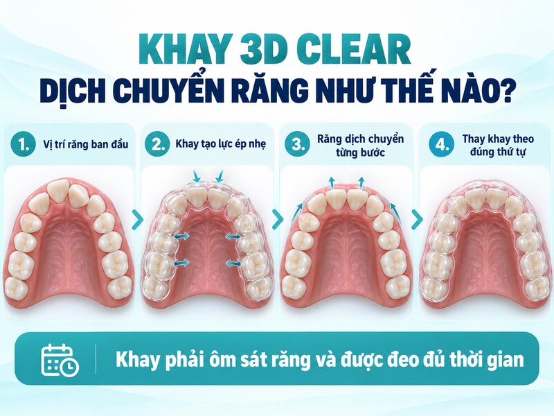 Quy trình tạo khay thường bắt đầu bằng việc khám răng,