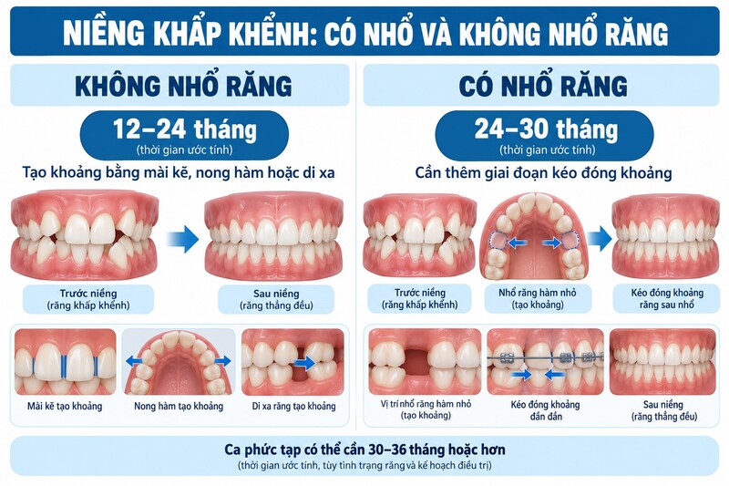 Thời gian niềng răng khấp khểnh khi có nhổ và không nhổ răng