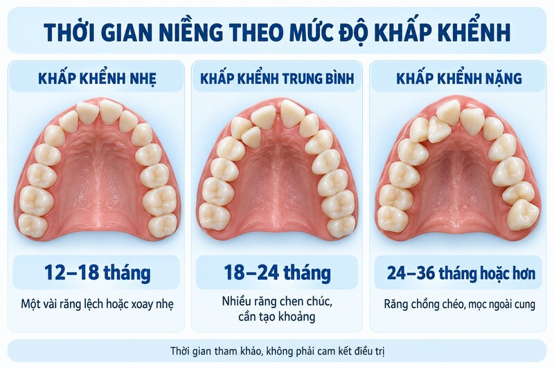 Thời gian niềng răng khấp khểnh nhẹ, trung bình và nặng