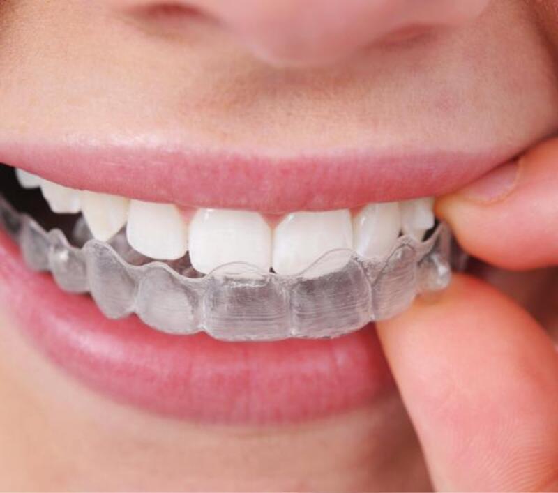 Hàm duy trì có thể cần điều chỉnh hoặc thay mới sau phục hình răng sứ