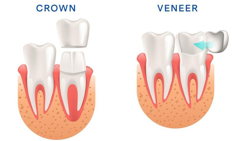 Veneer thường bảo tồn mô răng hơn, còn mão sứ phù hợp với một số răng tổn thương lớn