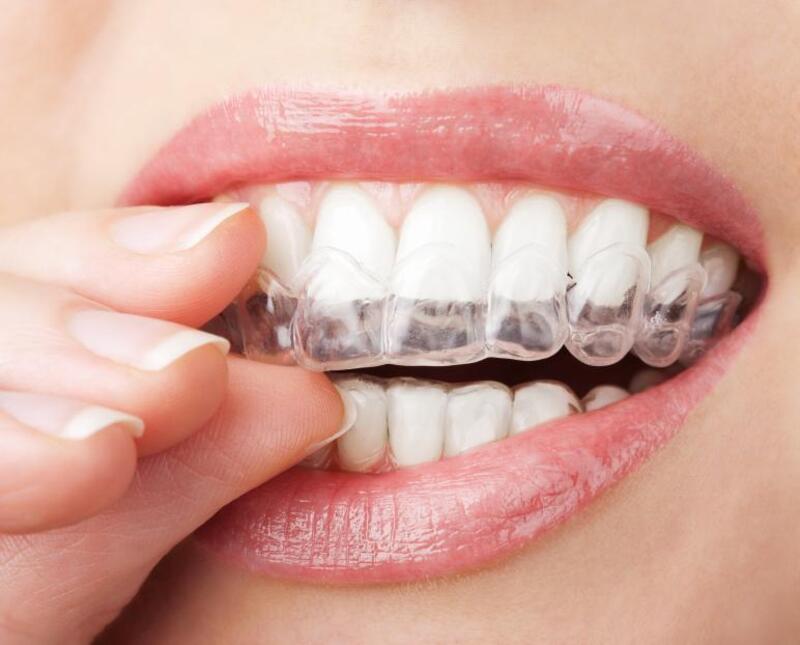 Sau niềng có thể làm răng sứ nếu tình trạng răng và khớp cắn phù hợp