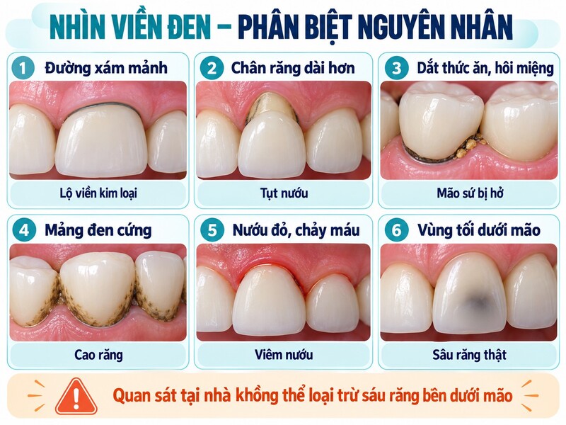 Răng sứ đen viền không nhất thiết phải thay toàn bộ các mão