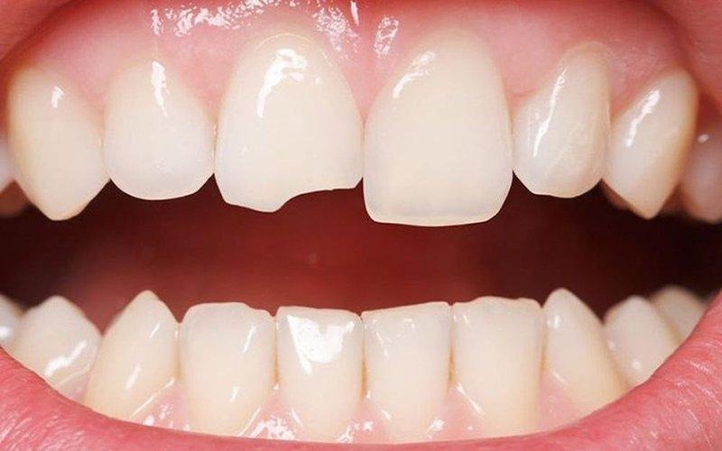 Răng sứ bị mẻ cần kiểm tra mức độ tổn thương để lựa chọn phương pháp xử lý