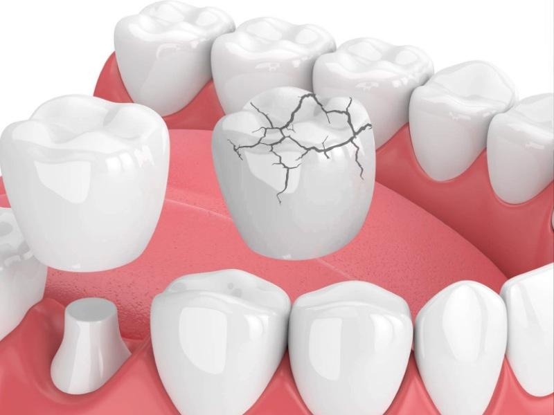 Mẻ nhỏ, mẻ lớp sứ phủ và vỡ lớn có phương án phục hồi khác nhau