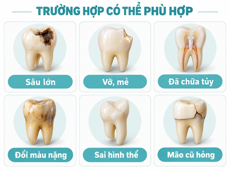 Bọc mão được cân nhắc khi răng cần phục hồi hình thể, độ bền hoặc chức năng ăn nhai.