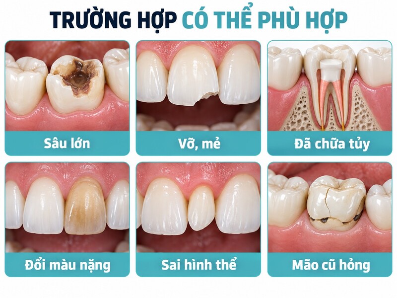 Mão Dmax có thể được cân nhắc khi răng cần phục hồi cả hình thể và khả năng chịu lực.