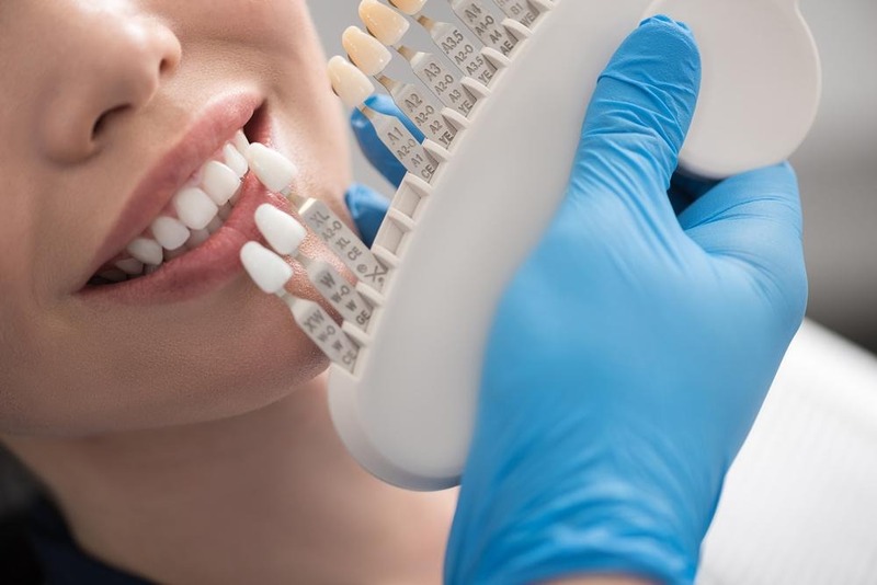 Màu mão sứ cần phù hợp với màu cùi và răng tự nhiên kế cận