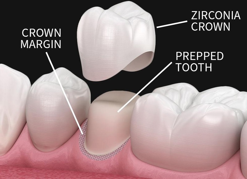 Mão Zirconia bao phủ cùi răng thật đã được sửa soạn