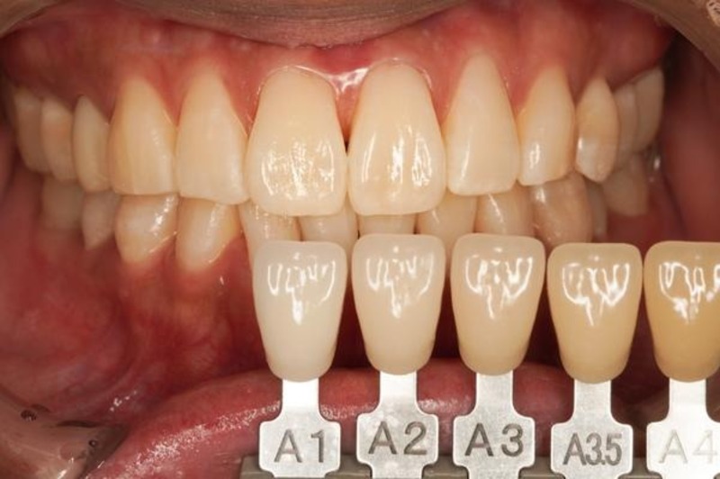 Mão sứ Zirconia bao phủ thân răng được sửa soạn, không có lõi kim loại